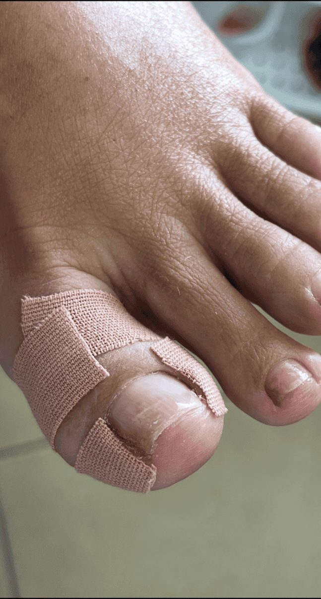 Strjen Lift Up Gel na nohtu palca, pridržan s trakom